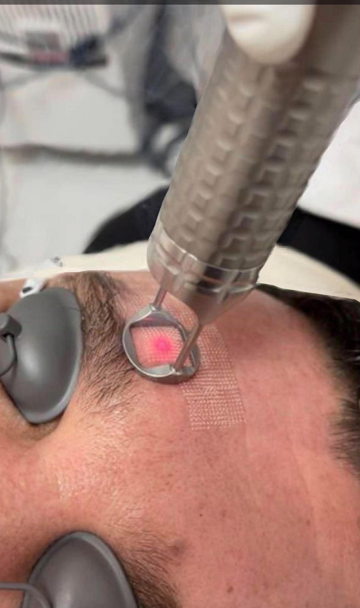CO2 fractional laser- Арьс шинэчлэх/Үрчлээ, сорив, толбо/